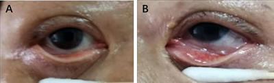 Case Report: A Re-Positive Case of SARS-CoV-2 Associated With Glaucoma